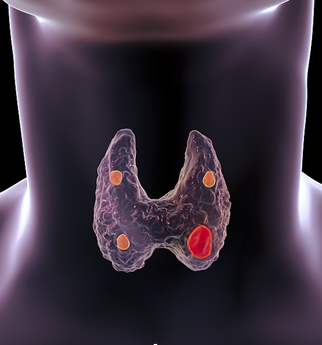Hyperparathyroïdie primaire causes principales